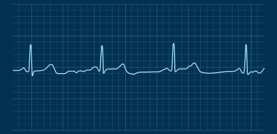 Normal heartbeat ECG
