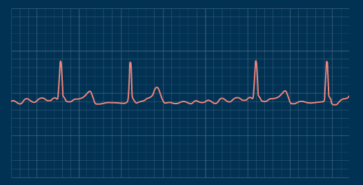 AFib heartbeat ECG
